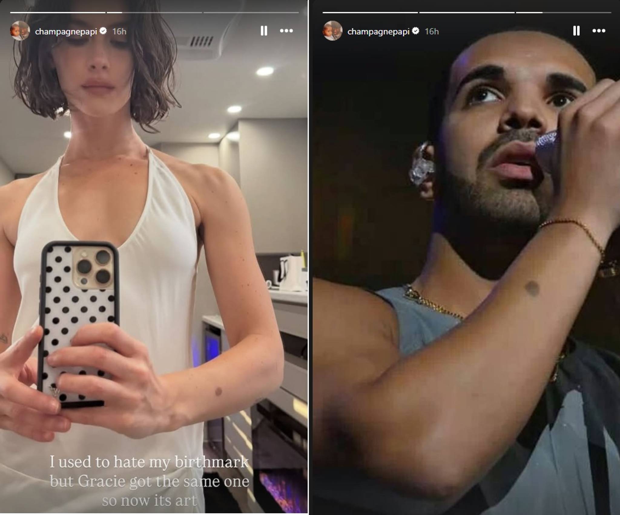 Drake opened up about how Gracie Abrams helped him get past hating a birthmark on his arm.